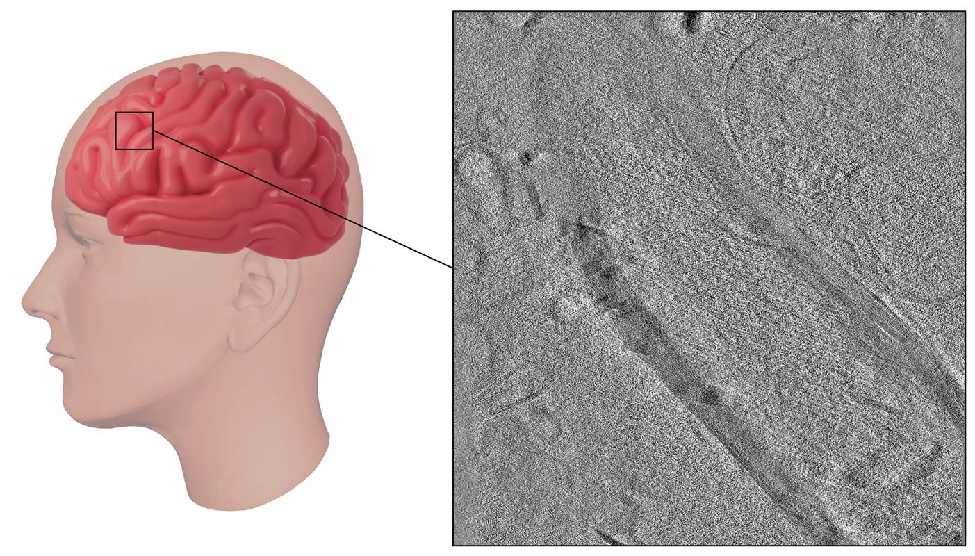 Anatomy Model Brain Diseased in Skull